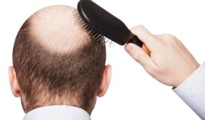 اسباب تساقط الشعر للرجال