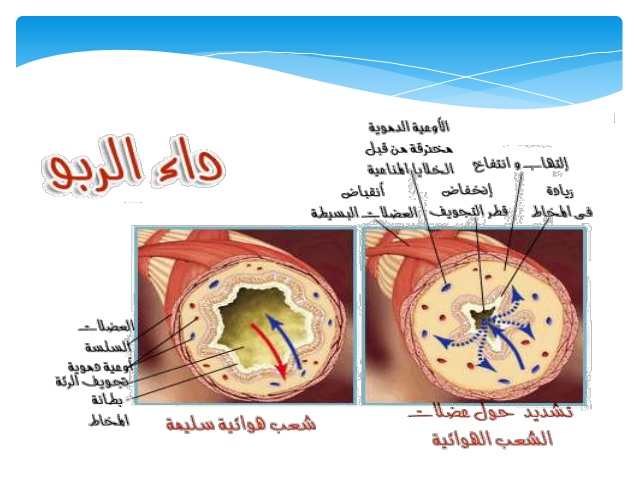 بحث عن مرض الربو ppt 2