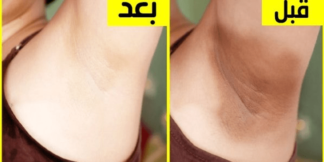 تجربتي مع بيكربونات الصوديوم للمنطقه