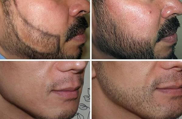 زراعة الذقن قبل وبعد