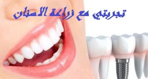 تجربتي مع زراعة الاسنان