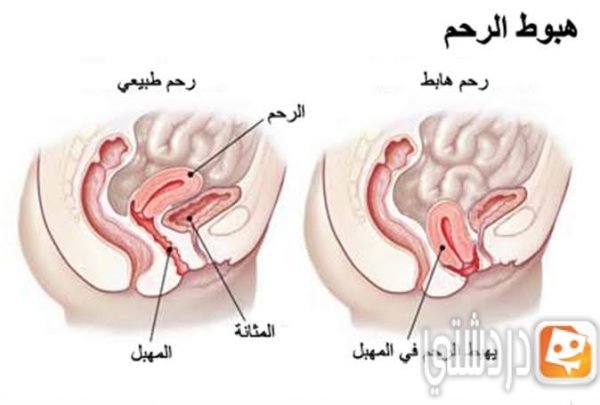  كيف أعرف ان الرحم نازل بعد الولادة 