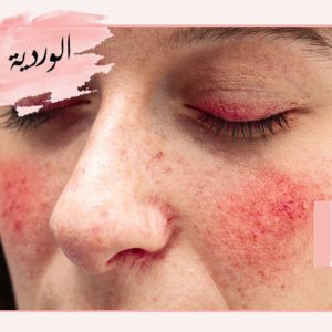تجربتي في علاج الوردية