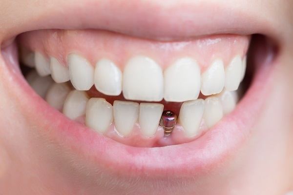 تجربتي مع زراعة الأسنان الأمامية