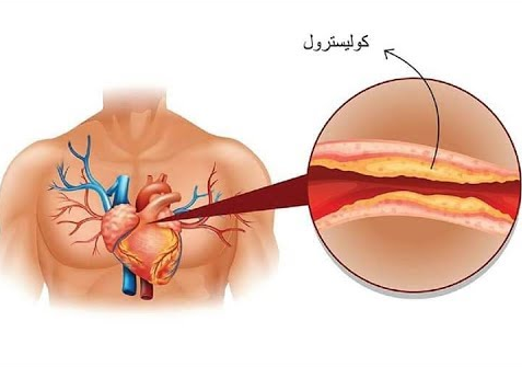 التخلص من الكولسترول نهائيا تجربتي في خفض الكوليسترول