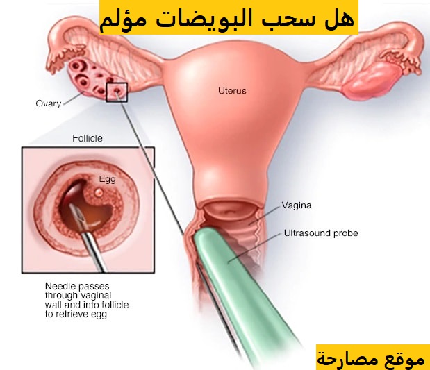 هل سحب البويضات مؤلم