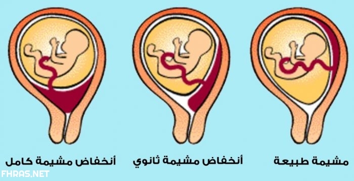تجربتي في رفع المشيمة