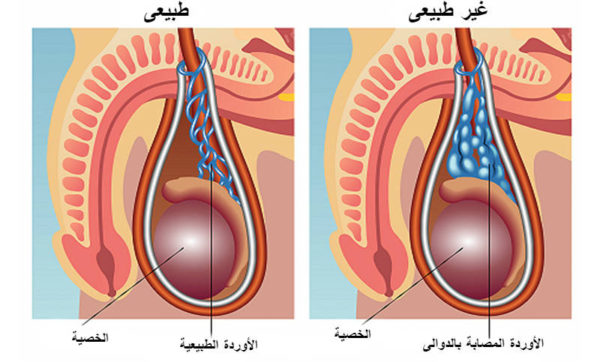 علاج ضمور الخصية بالاعشاب