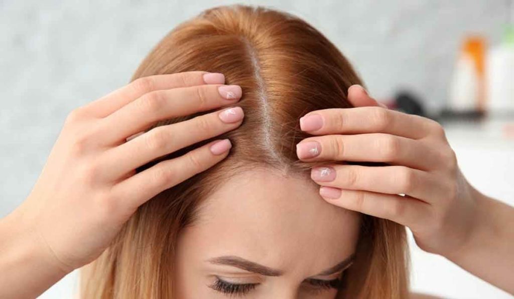 تجربتي في زراعة الشعر للنساء