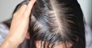 تجربتي في زراعة الشعر للنساء