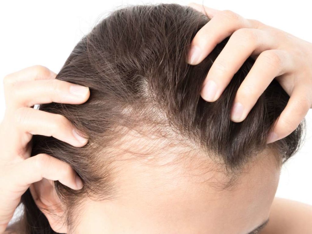 هل يجوز زراعة الشعر للنساء