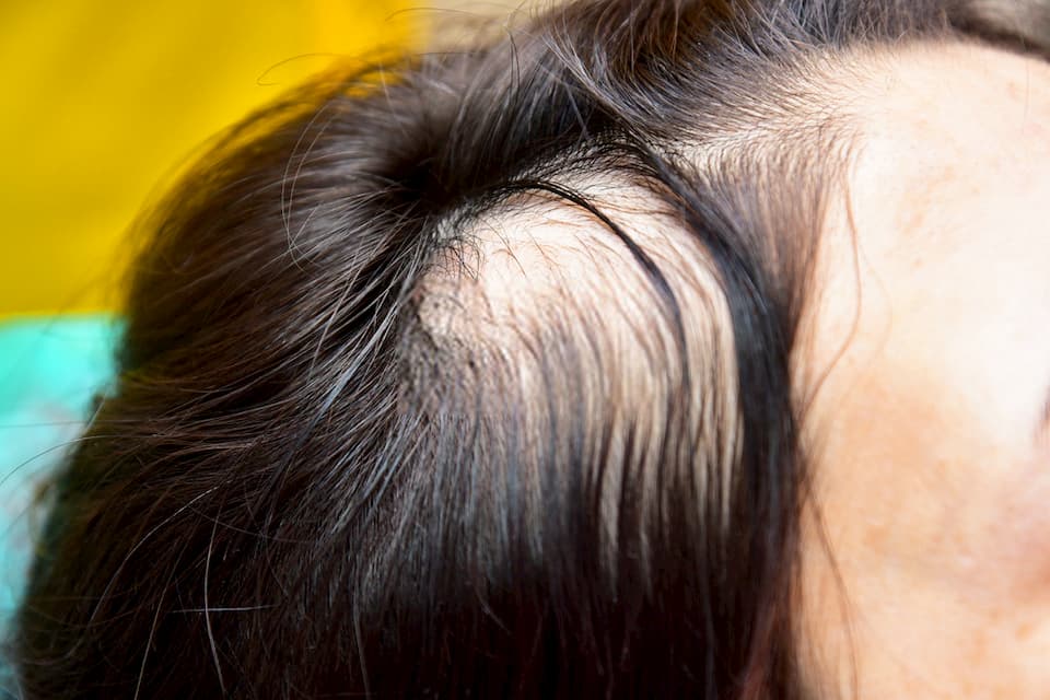 تجربتي الفاشلة مع زراعة الشعر