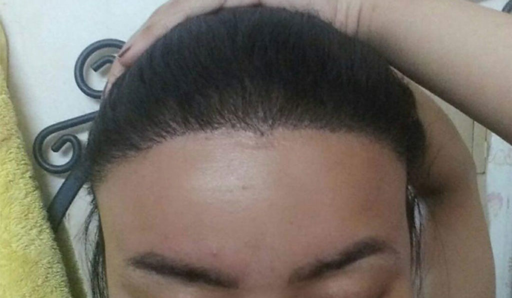 زراعة الشعر في تركيا تجربتي