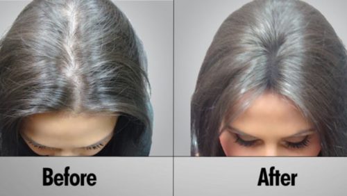 زراعة الشعر للنساء قبل وبعد