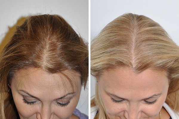 زراعة الشعر للنساء قبل وبعد