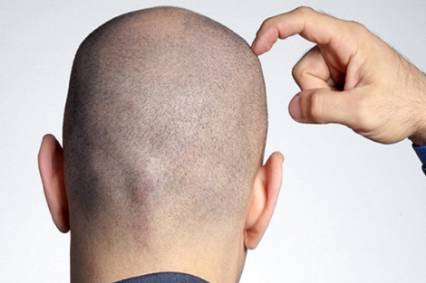 اضرار حلاقة الشعر بالموس للرجال 