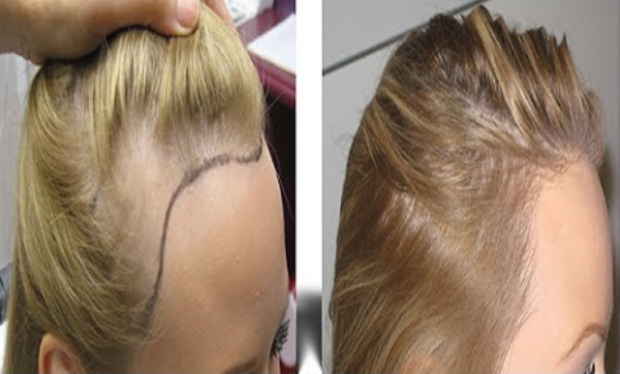 زراعة الشعر للنساء قبل وبعد