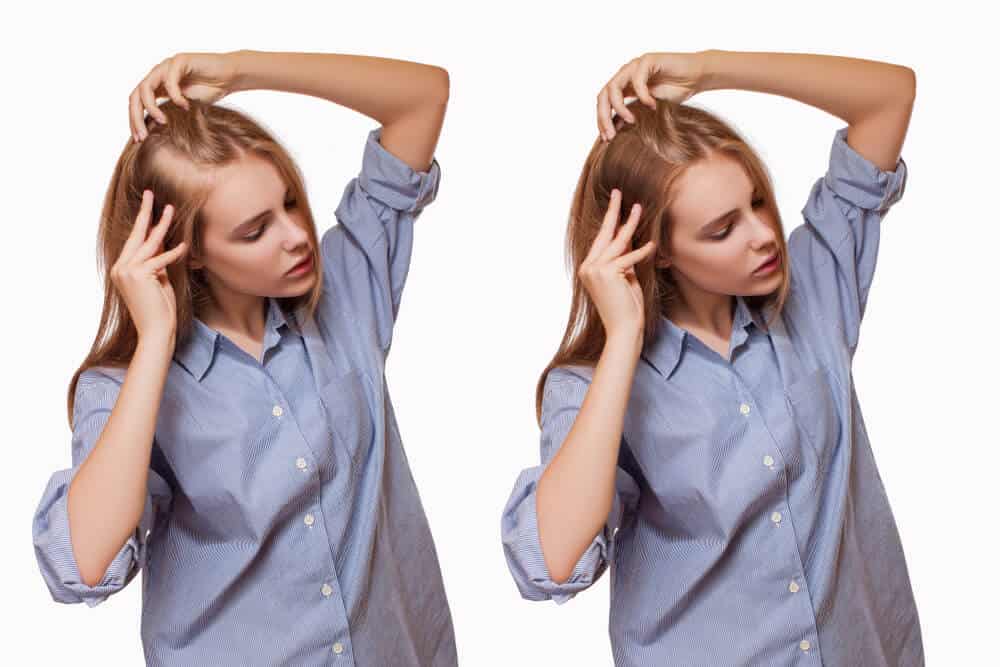 تجربتي مع زراعة الشعر في مصر