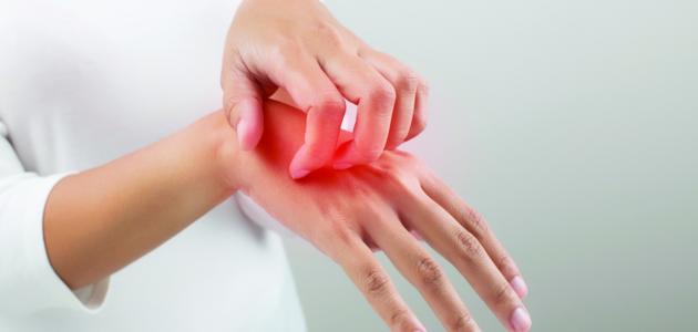 علاج الحساسية الجلدية والحكّة