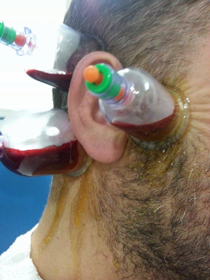 علاج ضعف السمع بالحجامة