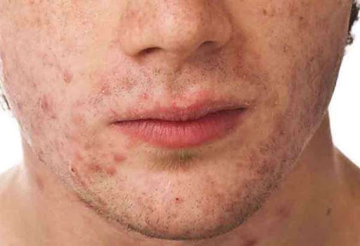 رقية شرعية لعلاج حبوب الوجه