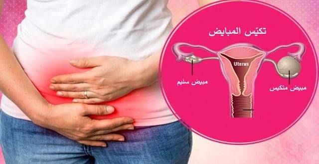 تجارب تكيس المبايض والحمل