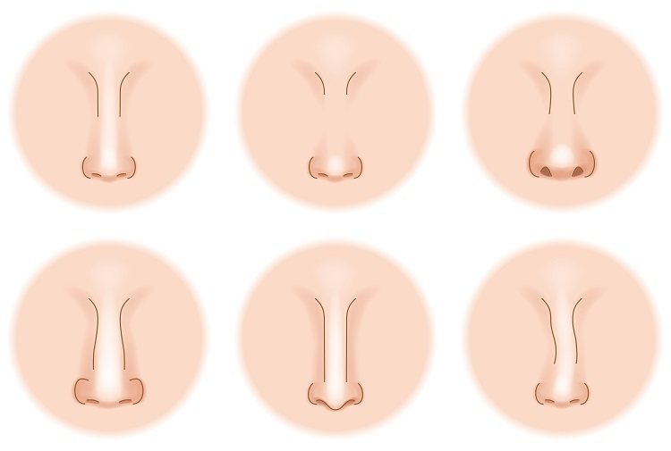 تجربتي مع عملية تجميل الانف - تجربتي مع تجميل الأنف بالليزر