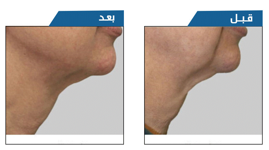جهاز الاكزيليس للوجه
