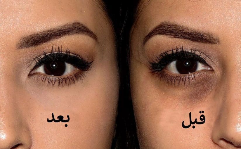 تخلص من تجاعيد تحت العين