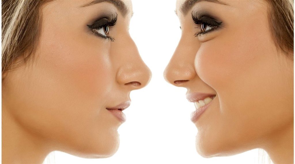 تجربتي مع تجميل الانف في تركيا