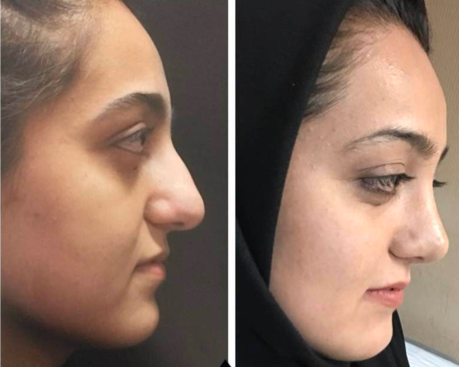 عمليات التجميل في تركيا كويتيات