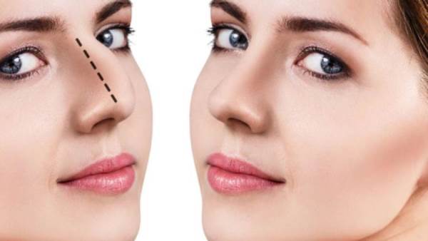 تجربتي مع تجميل الانف بالليزر