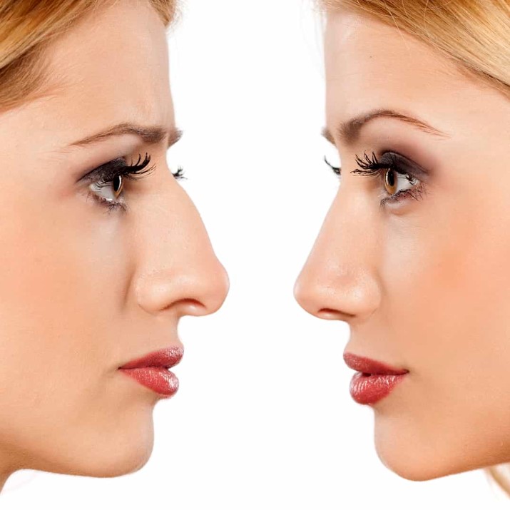 تجربتي مع تجميل الانف في تركيا