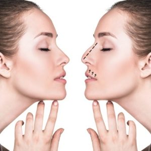 تجربتي مع تجميل الانف في تركيا