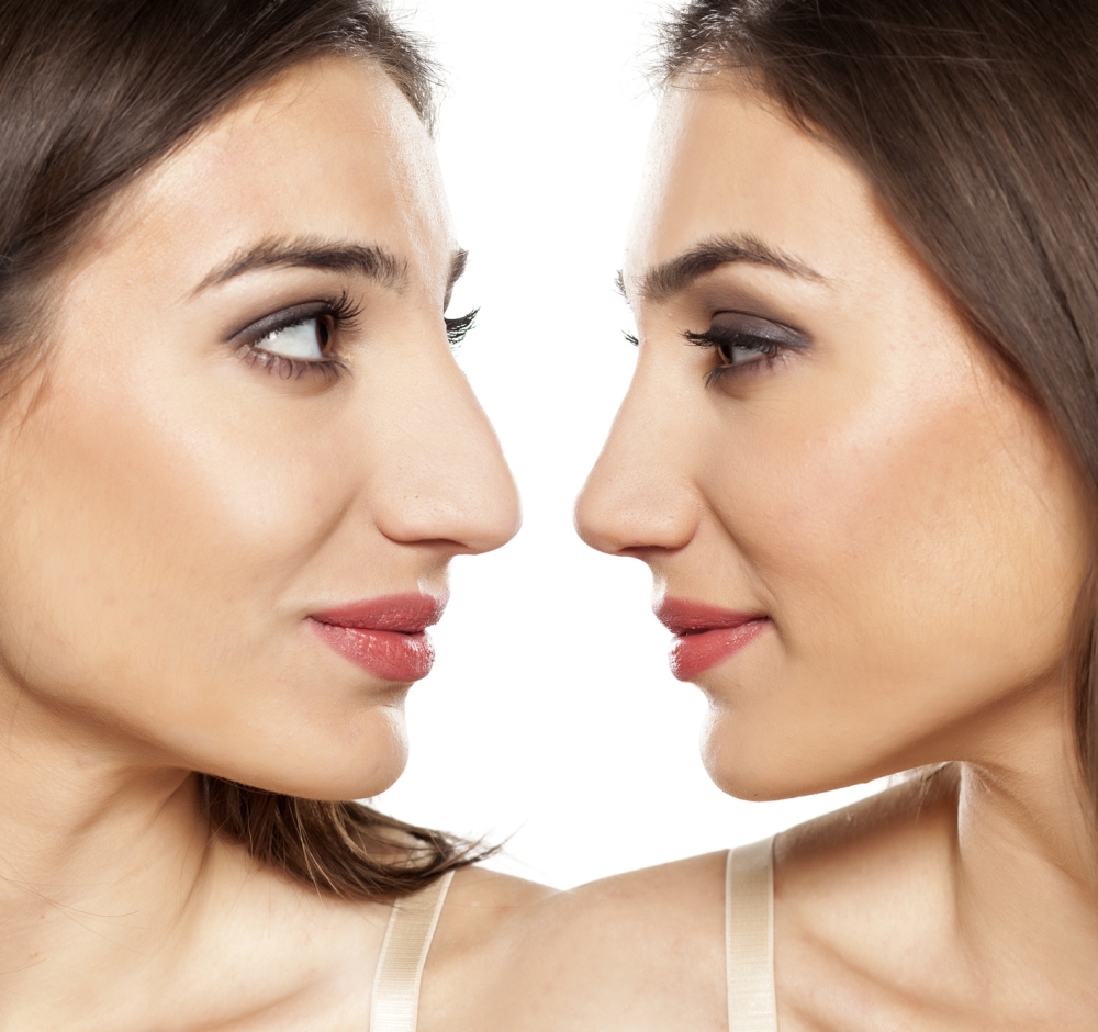 تجارب تجميل الأنف في تركيا