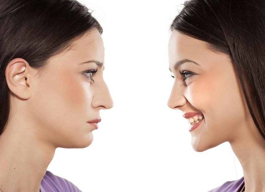 مين جربت الزنجبيل لتصغير الأنف - تجربتي مع تصغير الانف
