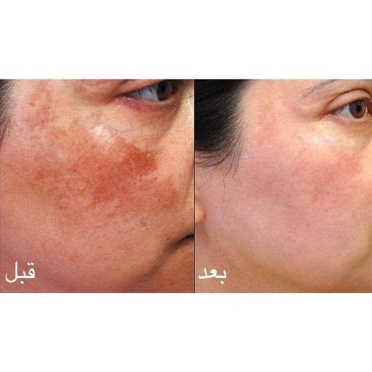 ميزوثيرابي للوجه قبل وبعد ٢