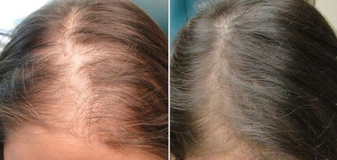 متى تظهر نتائج الميزوثيرابي للشعر