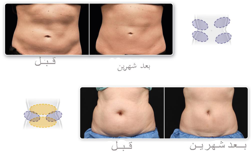 تجربتي مع جهاز الزلتيك