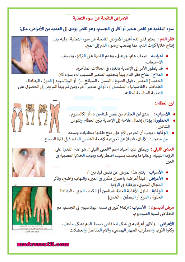 مطويات عن سوء التغذية 3