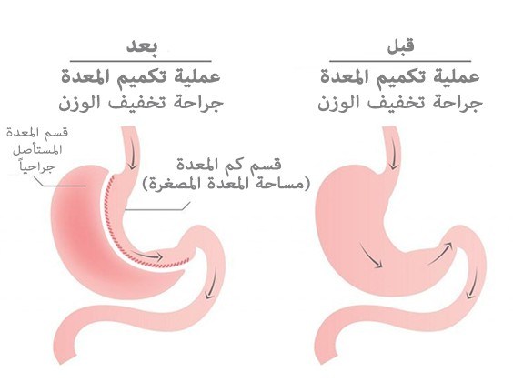 افضل طبيب تكميم في دبي