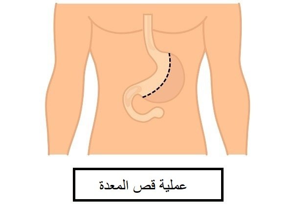 أفضل دكتور قص معدة في أبوظبي