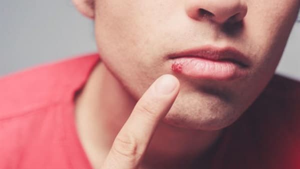 متى تظهر أعراض الإيدز في الفم - أعراض الإيدز بالصور ٤
