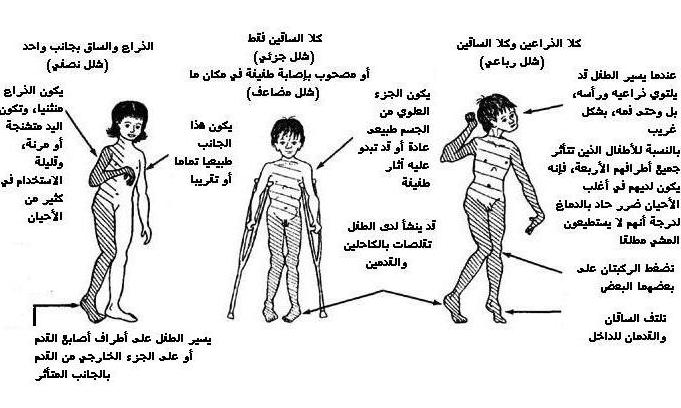 مطويات عن الشلل الدماغي 1