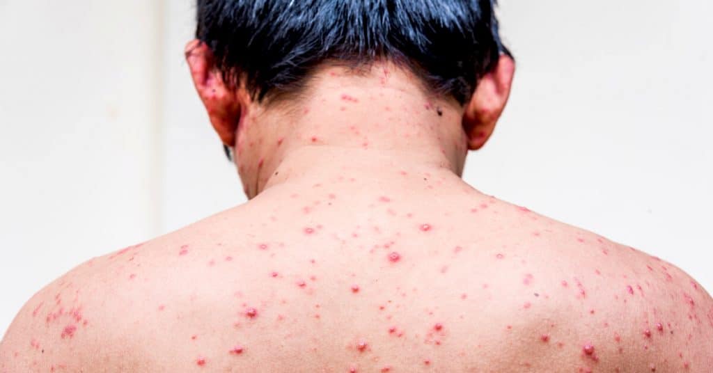 أعراض الإيدز بالصور ٢