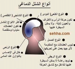 مطويات عن الشلل الدماغي 2