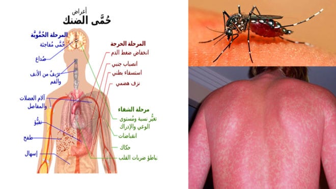 هل حمى الضنك خطير