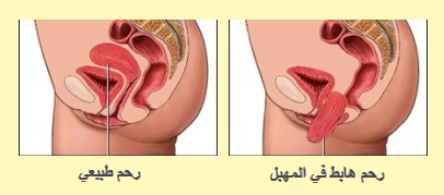 هبوط الرحم بالصور ٤