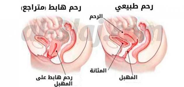 هبوط الرحم بالصور ٥