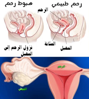 هبوط الرحم بالصور ٦